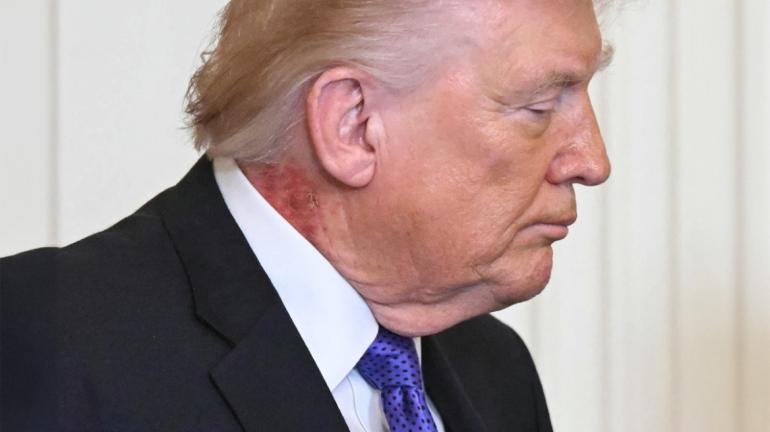 ΒΙΝΤΕΟ-Εξάνθημα στον λαιμό του Τραμπ προκαλεί νέα ερωτήματα για την υγεία του