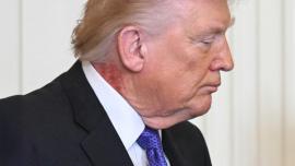 ΒΙΝΤΕΟ-Εξάνθημα στον λαιμό του Τραμπ προκαλεί νέα ερωτήματα για την υγεία του