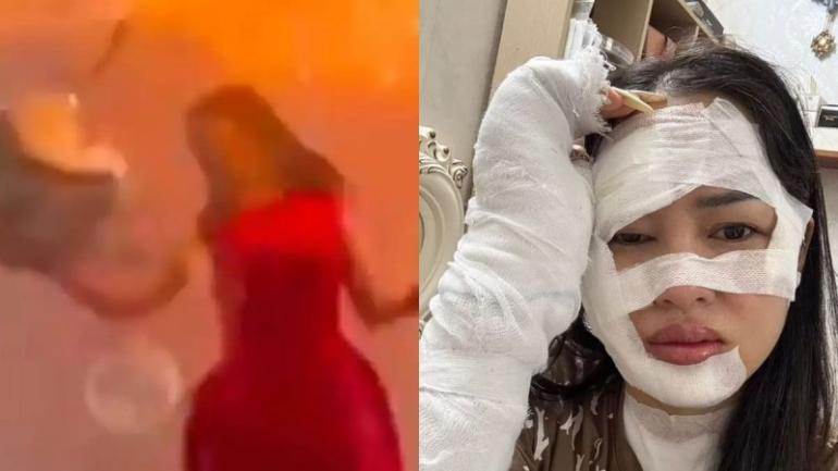 ΒΙΝΤΕΟ-Γενέθλια φρίκης για 33χρονη – Έσκασε στο πρόσωπό της μπαλόνι με υδρογόνο που ακούμπησε στα κεριά της τούρτας της